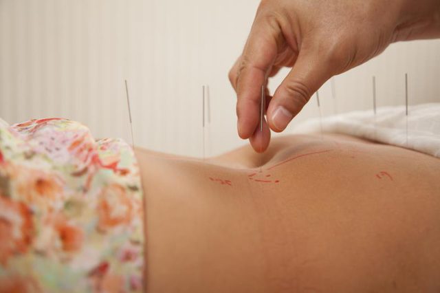 Acupuncture Brisbane