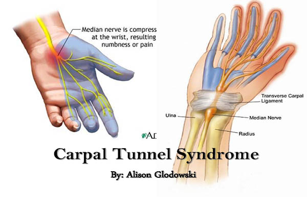 Carpal Tunnel Syndrome