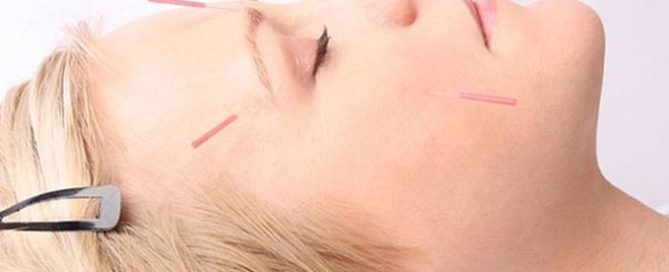 Facial Acupuncture Brisbane