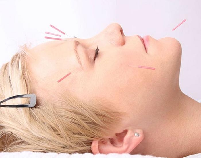 Facial Acupuncture Brisbane