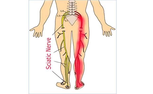 Sciatica Acupuncture