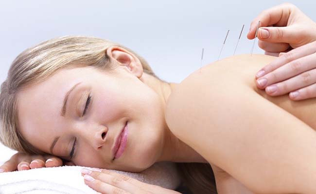 Acupuncture needles on the back of a beautiful woman Acupuncture Therapy