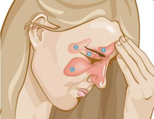 Chronic sinusitis