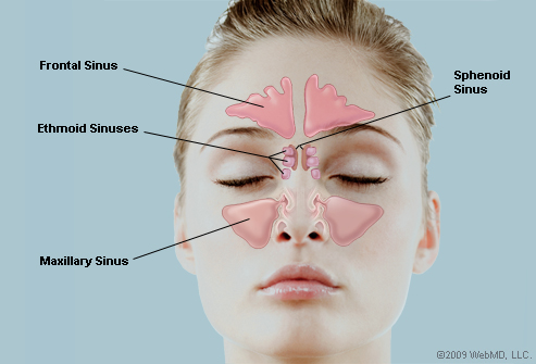 sinuses Sinusitis relief means draining phlegm from sinuses