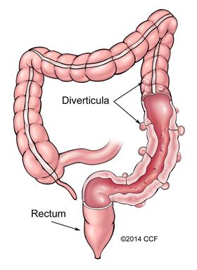 Diverticulosis is part of diverticular disease