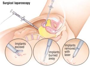 Laparoscopy and TCM