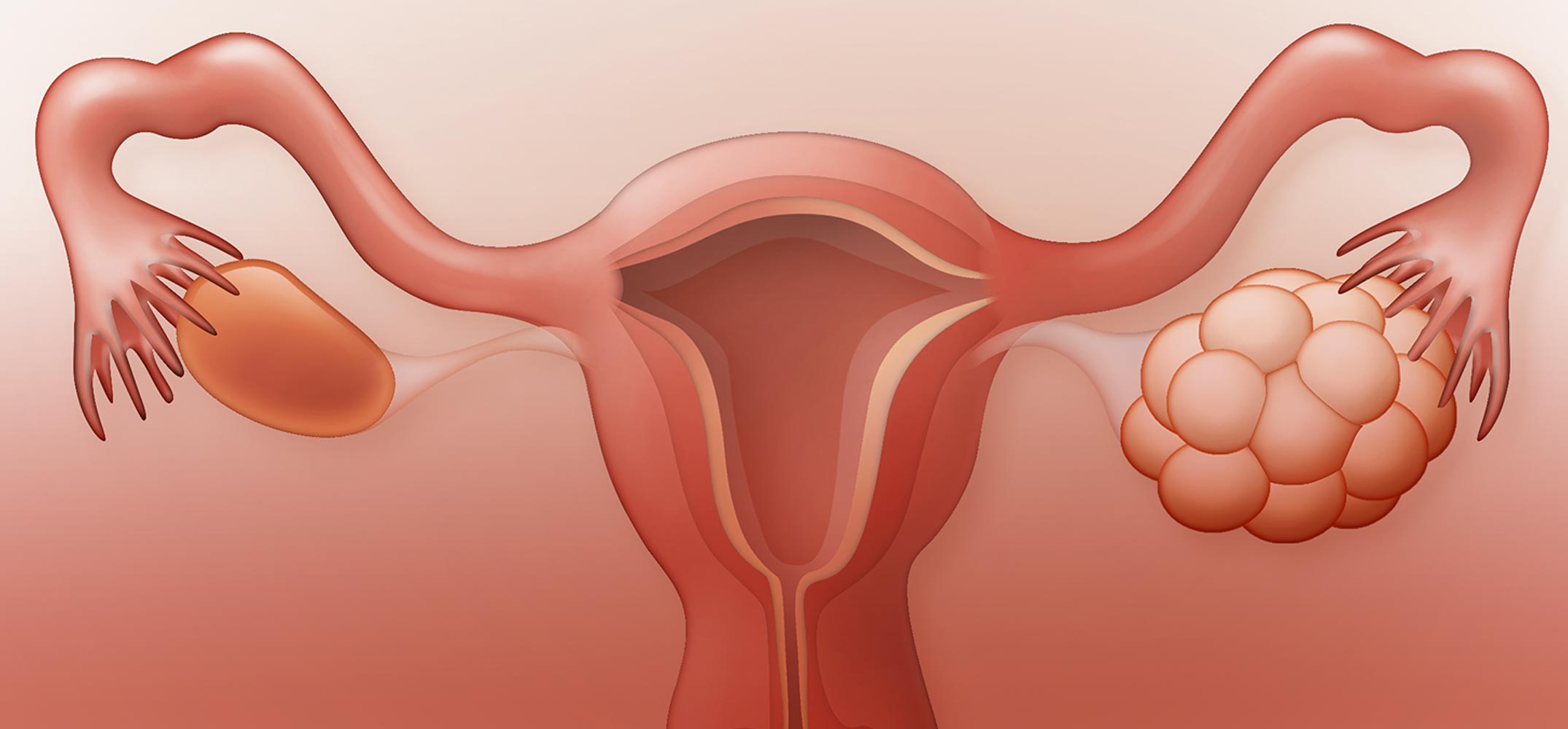Poly Cystic Ovarian Syndrome PCOS