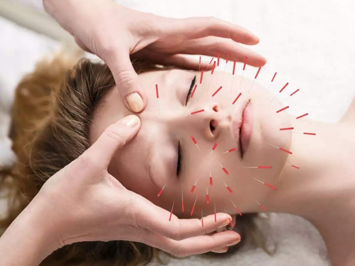 Cosmetic Acupuncture Brisbane